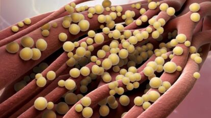 Infection à staphylocoque doré : Résultats de l’étude SABATO