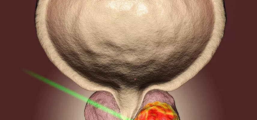 Etude AMPLITUDE: Cancer de la prostate avec mutation HRR