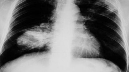 NéoCOAST-2 : Nouvel espoir avant la chirurgie du cancer du poumon