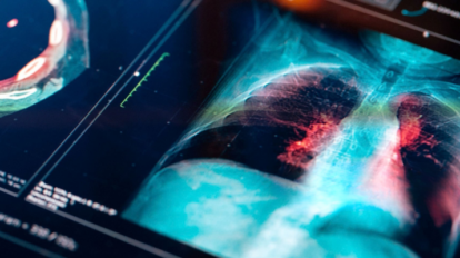 Dépistage du cancer du poumon : Participez à l'étude
