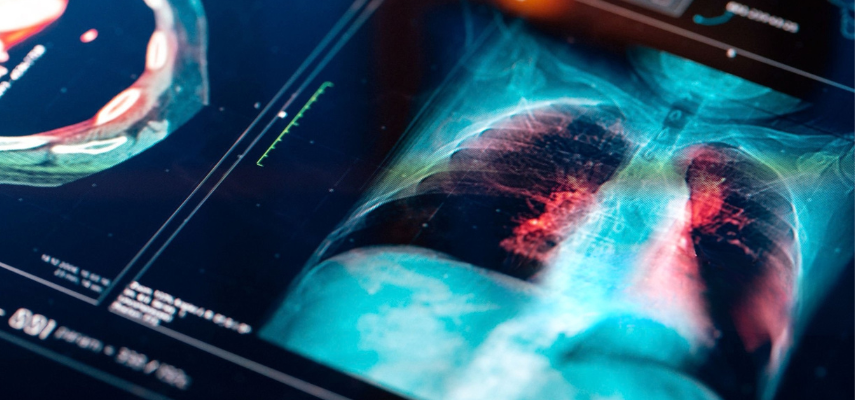 Dépistage du cancer du poumon : Participez à l’étude